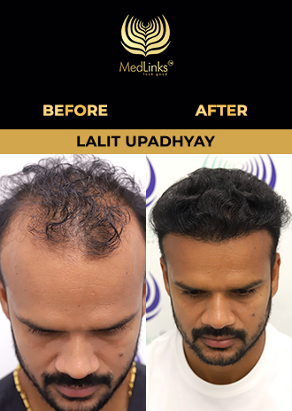 Varun Verma hair transplant before and after